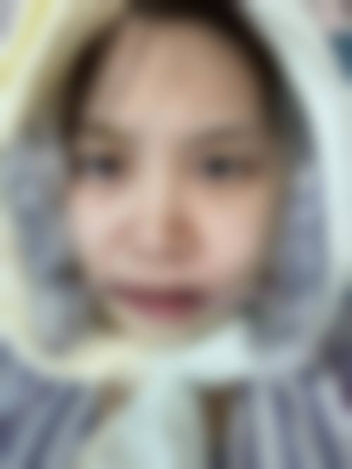 地包天矫正后脸型改变的个体差异分析