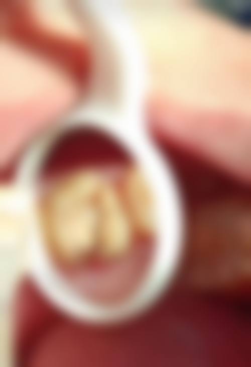 根管治疗注意事项