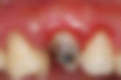 牙齿问题的正确处理方式