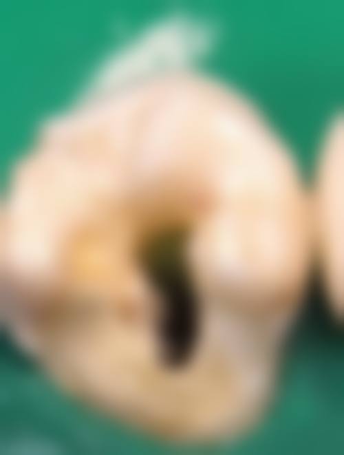 自己动手补牙的操作难度