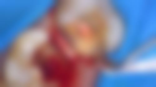 自己补牙可能引发的潜在风险