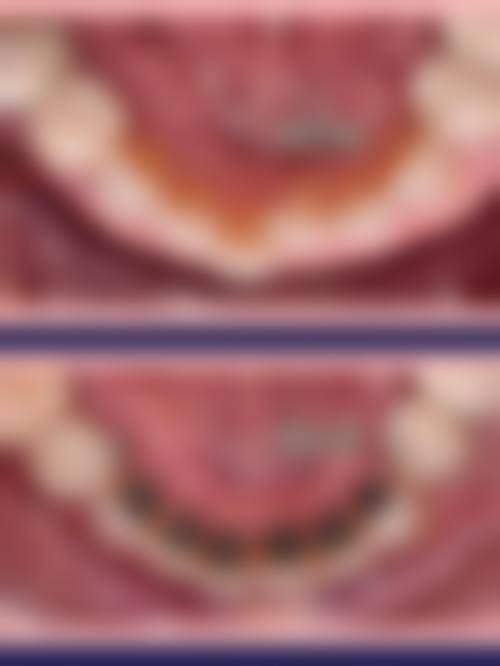 儿童乳牙期：矫正牙齿的黄金起点