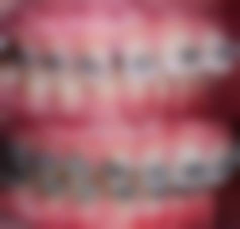 重度骨性畸形：正颌手术来帮忙