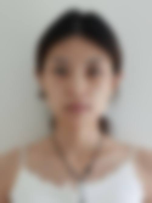 徐氏祛眼袋综合整形法