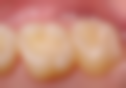 贵阳牙齿矫正相关项目价格