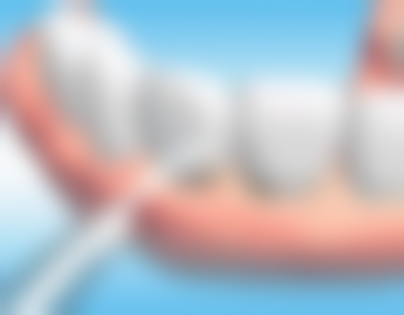 替牙期：6 - 12岁，密切观察适时干预