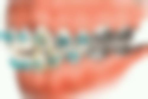 5. 地区差异对深覆合矫正费用有何影响？