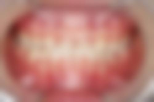 不同矫正方式费用