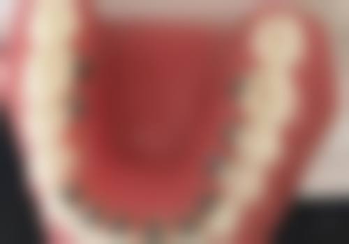 二、佩戴金属托槽矫治器