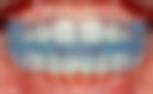 天包地自我矫正训练之定期监测进展