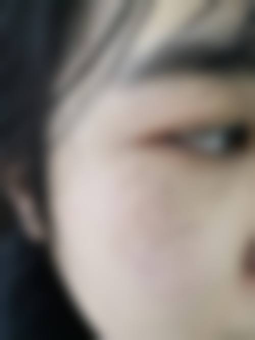 安徽医 科 大学第四附属医院烧伤整形科真实实例与优势