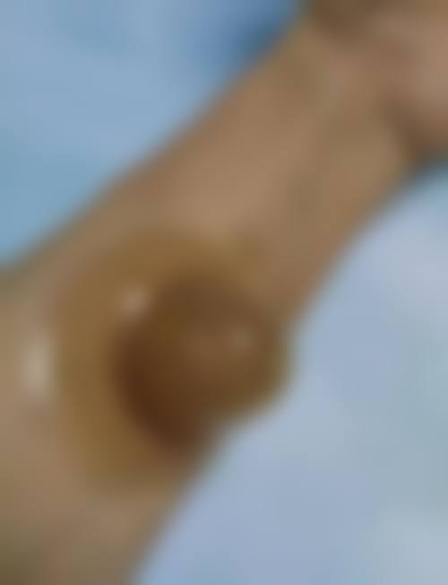 安徽医 科 大学第四附属医院烧伤整形科项目与价格介绍