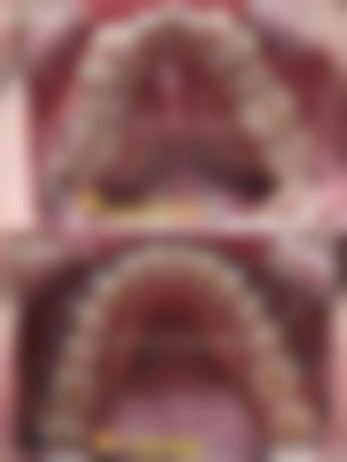 26岁牙齿矫正费用的具体实例分析