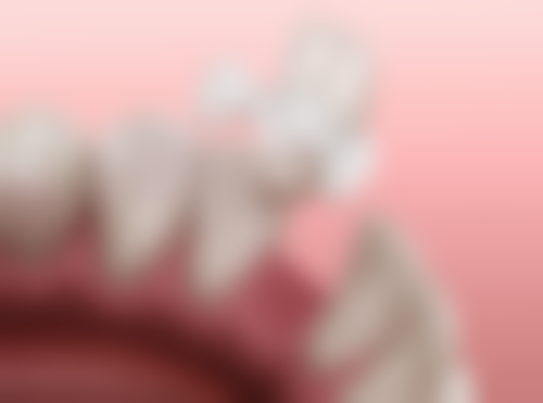 牙喜士口腔微创即刻种植技术