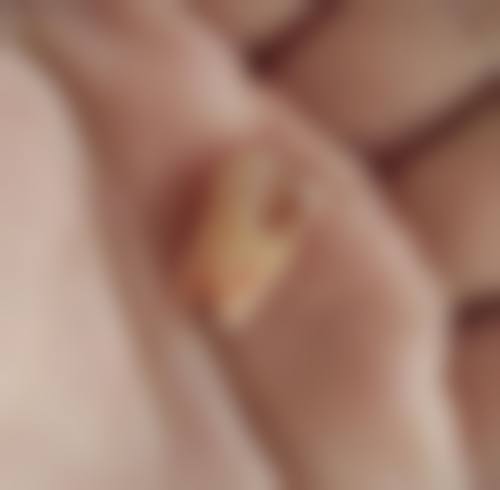 二、智齿牙髓炎发炎时拔牙可行吗？
