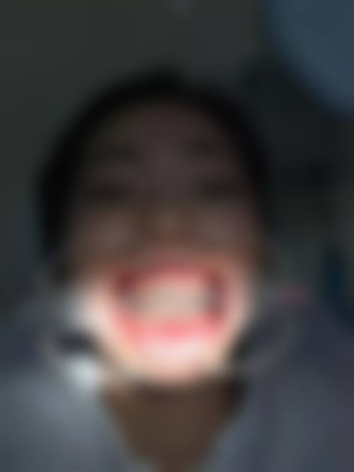 三、牙齿畸形程度对费用的影响