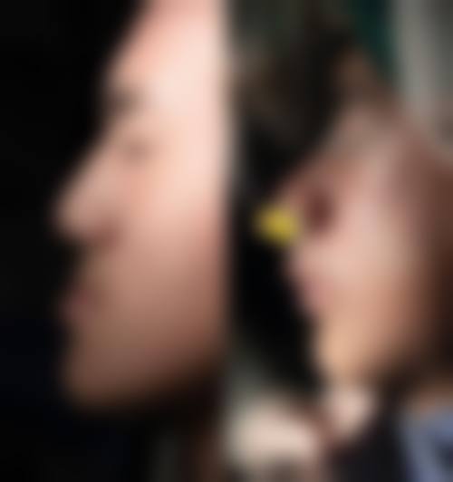 五、不同矫正方法对反弹的影响
