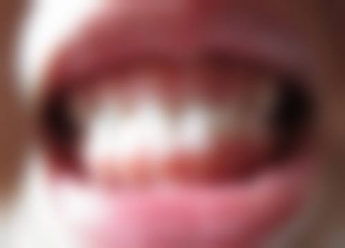 地包天矫正后的成效评估