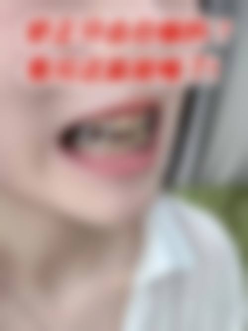 地包天手术治疗的方式