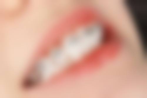 儿童不同阶段矫正牙齿的医院选择