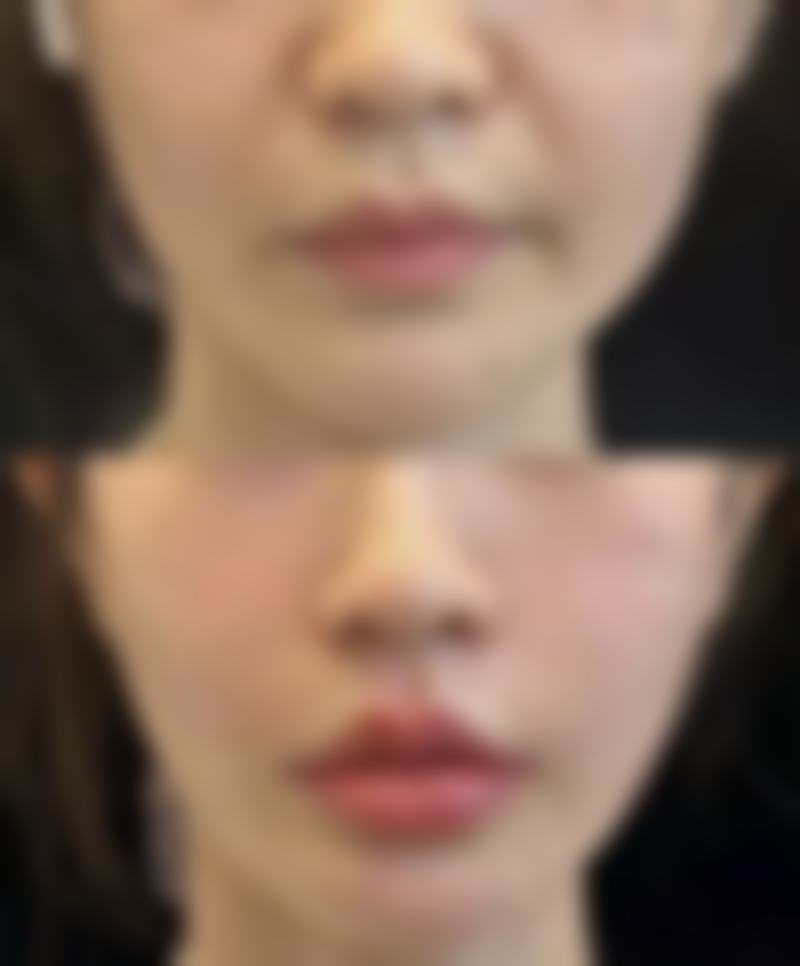 广州珈禾李勤医生的口碑怎么样?听听这些真实求美者的心里话